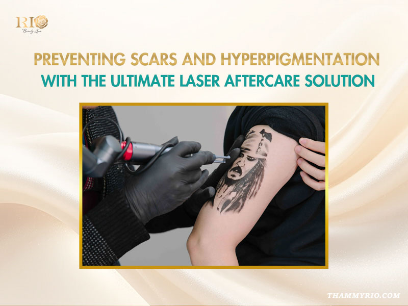 Melsmon Mira Tattoo Removal Recovery Cream prevents scars and hyperpigmentation after laser treatment.