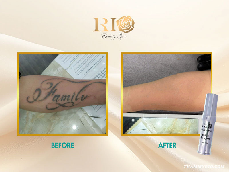 Before and After comparison of laser tattoo removal results using Melsmon Mira Tattoo Removal Recovery Cream at Rio Beauty Clinic.