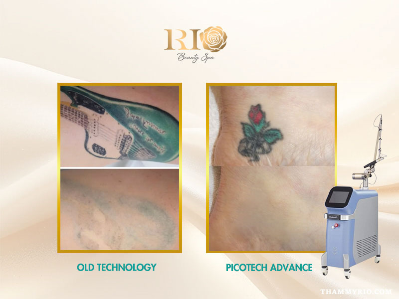 Comparison of Cobalt Blue tattoo removal: Standard laser vs Picotech Advance Laser results at Rio Beauty Clinic.