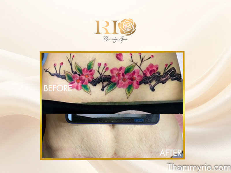 Before and after removing multi-color tattoo using Ruby Laser Alpha 6 694nm wavelength on green blue and red ink