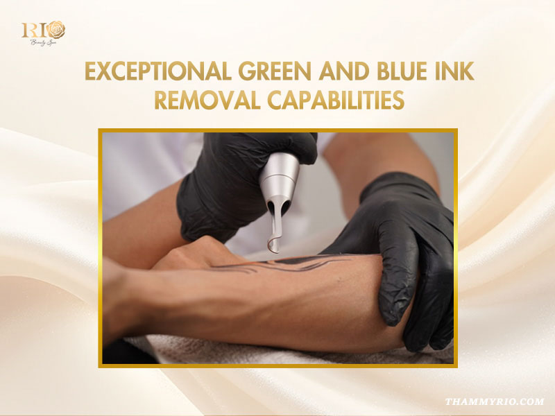 Exceptional green and blue ink removal capabilities of Ruby Laser Alpha 6 at Rio Beauty Clinic
