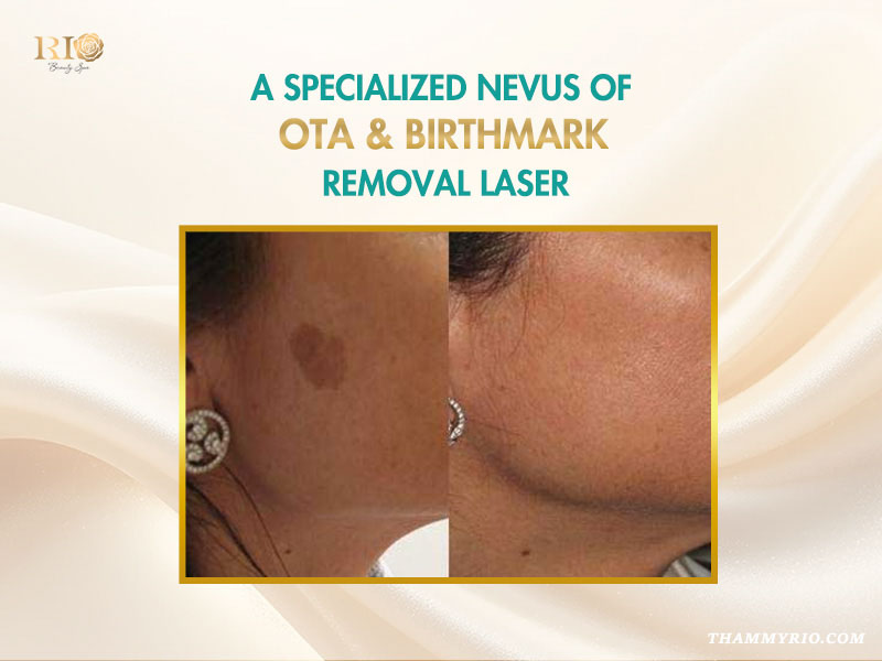 Specialized nevus of Ota and birthmark removal using Ruby Laser Alpha 6 technology at Rio Beauty Clinic