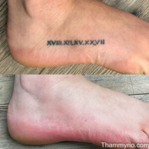 Before and after laser treatment for removing a roman numeral tattoo on the side of a foot.