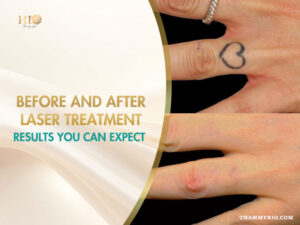 Real results of before and after laser treatment for a heart tattoo on a finger.