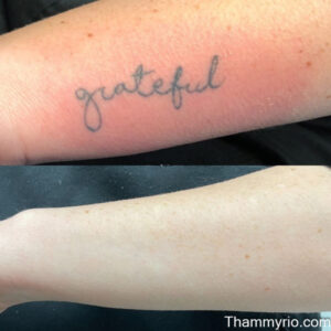 Before and after laser treatment for removing a cursive grateful word tattoo on the forearm.