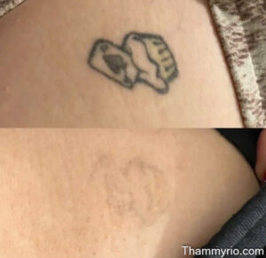 Realistic before and after laser treatment timeline for crown tattoo removal behind the ear.