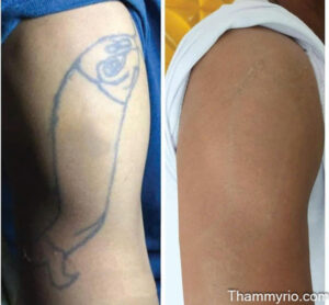 Comparison showing before and after laser treatment for a fish tattoo on an arm.