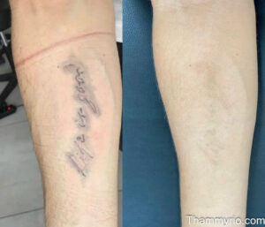 Before and after laser treatment for tattoo removal on a forearm showing the script life is good fading completely.