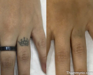Before and after laser treatment for crown tattoo removal on a person's finger.