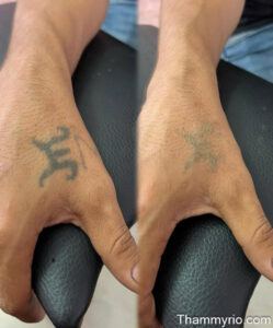 Before and after laser treatment for tattoo removal on hand.