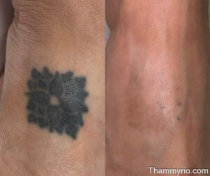 Before and after laser treatment for a square geometric black ink tattoo removal on skin.