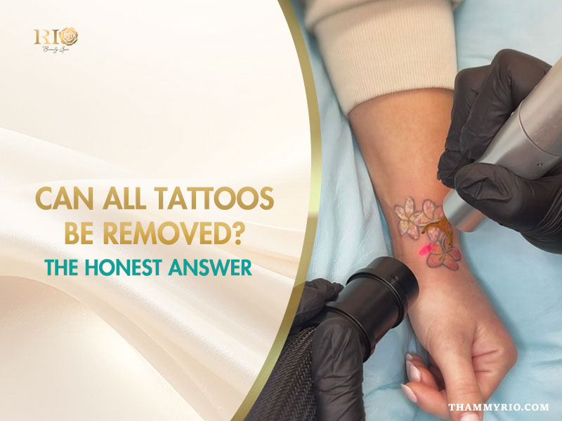A person receiving laser treatment to answer can all tattoos be removed for a floral wrist tattoo.