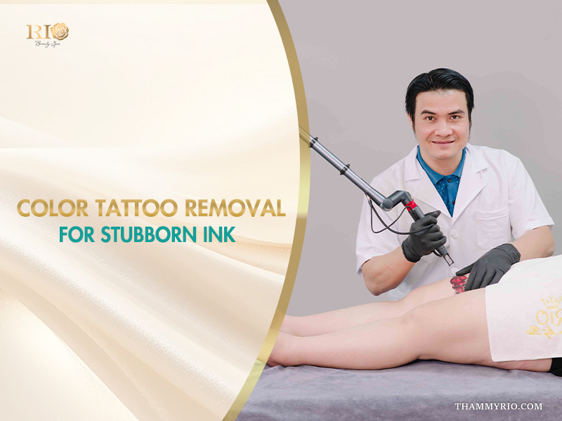 Professional laser color tattoo removal for stubborn ink at Rio Beauty Spa.