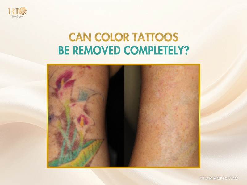 Rio Beauty Spa offers safe and effective color tattoo removal for stubborn ink. Our advanced laser technology ensures precise results with minimal discomfort for all skin types.