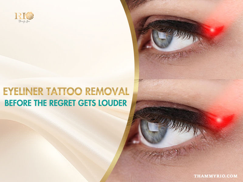 Close-up of laser eyeliner tattoo removal process at Rio Beauty Spa.