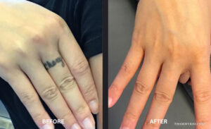 Before and after results of finger tattoo removal showing a script name tattoo on the ring finger being completely erased.