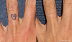 Before and after results of finger tattoo removal showing a small heart tattoo on the ring finger completely faded.