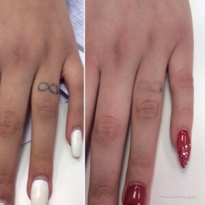 Before and after comparison showing the significant fading of a small black infinity loop tattoo on a woman's finger after professional removal treatment.