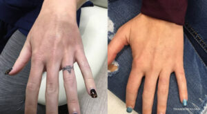 Before and after comparison of finger tattoo removal on a woman's hand showing a small ring tattoo completely vanished.