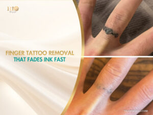 Close-up of finger tattoo removal results showing a ring tattoo fading significantly between two sessions.