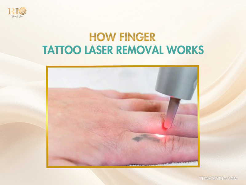 Professional laser removal of a small faded tattoo on a finger at Rio Beauty Spa.