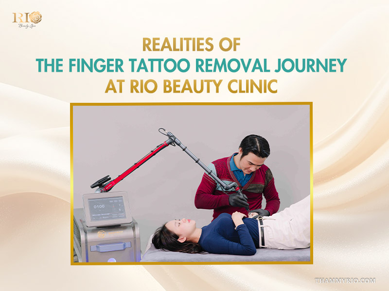 Expert technician performing finger tattoo removal for a female client using advanced laser technology at Rio Beauty Clinic.