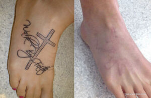 Before and after results of a foot tattoo removal process for a cross and script design.