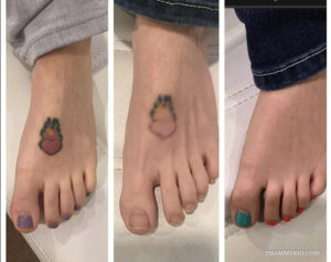 Three-step comparison of laser foot tattoo removal for a heart on fire design.