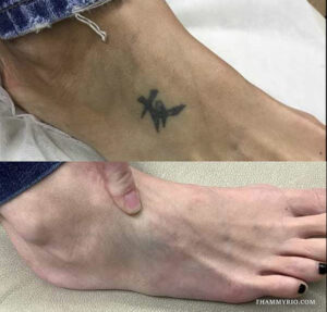 Before and after results of foot tattoo removal showing complete fading of black ink on the ankle.