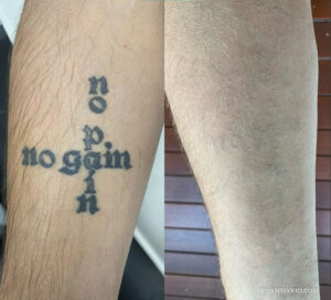 Before and after results of a black ink foot tattoo removal showing complete fading.