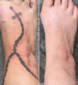 A split screen showing a clear before and after comparison of successful foot tattoo removal.