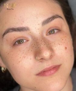 Natural-looking freckle tattoo results for a youthful sun-kissed look at Rio Beauty Clinic