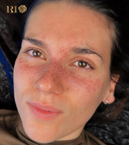 Celebrities and social media influencers choosing Freckle Tattoo Rio Beauty Clinic for a trendy look