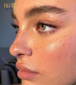 Extreme macro of natural freckle tattoo at Rio Beauty Clinic - Realistic and sun-kissed details