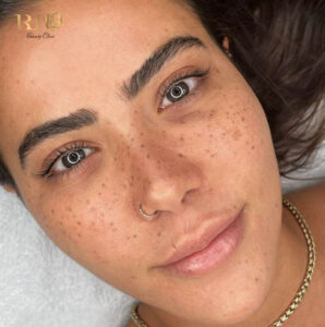 Customized Freckle Tattoo Rio Beauty Clinic using premium pigments for a natural sun-kissed look