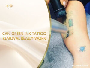 Professional laser treatment process for green ink tattoo removal on a patient's arm.