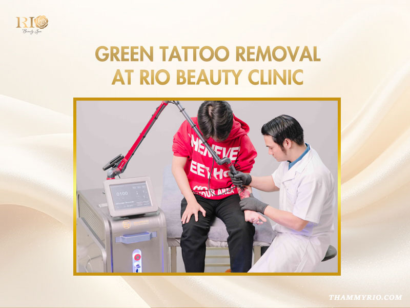 pecialist performing green ink tattoo removal using a high-tech laser machine at Rio Beauty Clinic.
