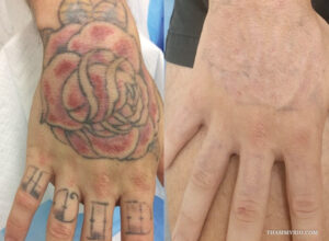 Before and after hand tattoo removal showing a large rose and finger letters fading.
