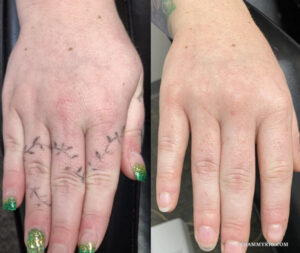 Progress of hand tattoo removal on fingers showing vine-like ink patterns fading over time.