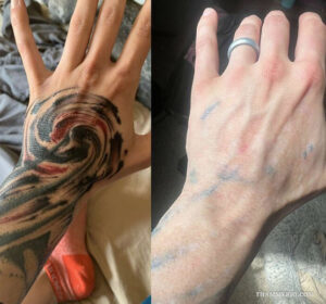 Large black and red swirling hand tattoo removal before and after showing significant fading.