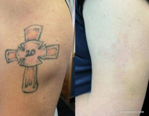 Before and after hand tattoo removal of a cross symbol with number 20 and orange shading.