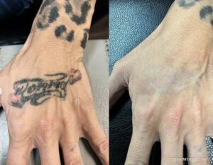 Before and after hand tattoo removal of leopard print patterns and cursive word with red hearts.