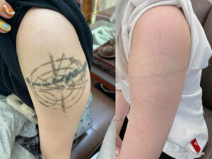 Before and after hand tattoo removal of a complex geometric and line-work design.