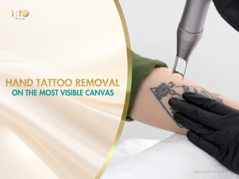 Professional hand tattoo removal procedure using advanced laser technology on a floral arm tattoo.