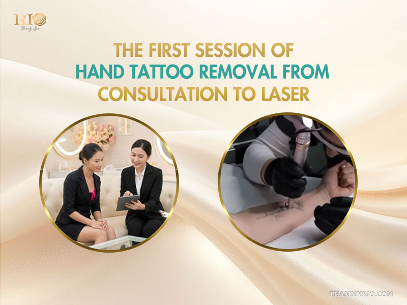 Safe and complete hand tattoo removal at Rio Beauty Clinic featuring professional laser equipment and procedure.