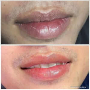 A detailed before and after comparison showcasing the process of how to get rid of lip tattoo, highlighting the dramatic fade and skin improvement for dark male lips.