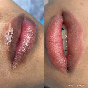 A detailed before and after comparison showing how to get rid of lip tattoo from dark lips to a natural pink shade via professional laser removal.