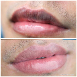 A close-up before and after comparison of male lip neutralization showing how to get rid of lip tattoo and dark pigmentation for a natural look.