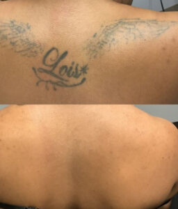 Before and after result of how to get tattoo off on the lower back using professional laser removal.