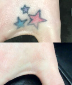 Before and after results of how to get tattoo off a hand using laser removal.